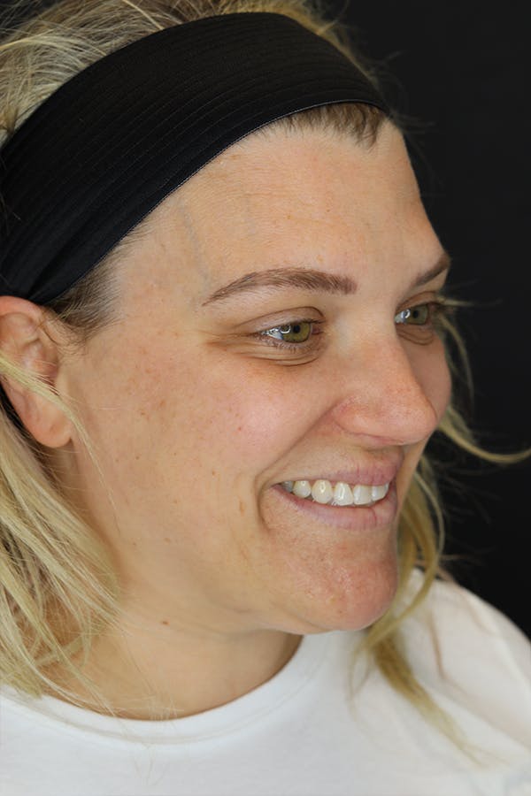 Neck Liposuction Before & After Gallery - Patient 57007672 - Image 7