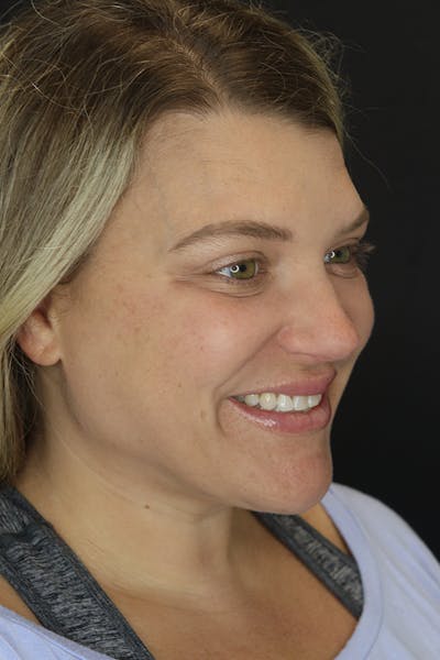Neck Liposuction Before & After Gallery - Patient 57007672 - Image 8