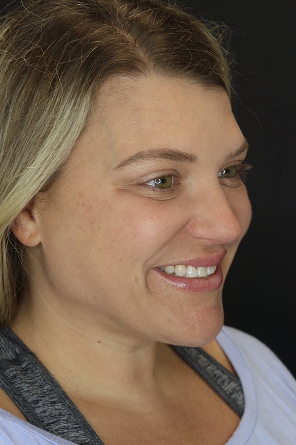 Neck Liposuction Before & After Gallery - Patient 57007672 - Image 8