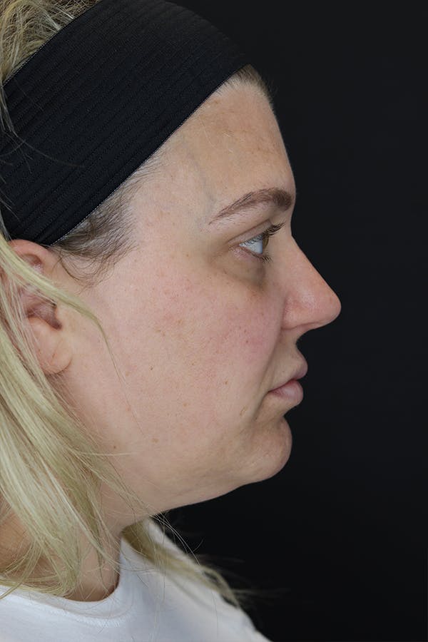 Neck Liposuction Before & After Gallery - Patient 57007672 - Image 9