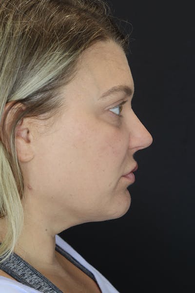 Neck Liposuction Before & After Gallery - Patient 57007672 - Image 10