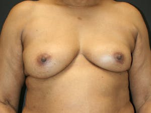 Before and after breast reconstruction