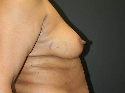 Breast Reconstruction Before & After Gallery - Patient 61447016 - Image 4