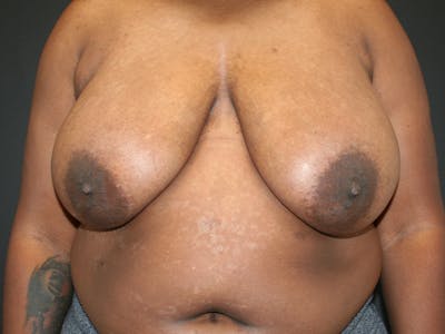 Breast Reduction Before & After Gallery - Patient 61447065 - Image 1