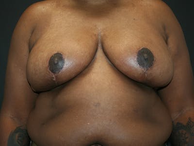 Breast Reduction Before & After Gallery - Patient 61447065 - Image 2