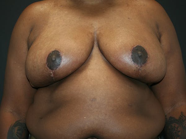 Breast Reduction Before & After Gallery - Patient 61447065 - Image 2