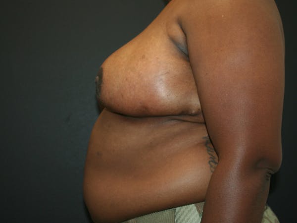 Breast Reduction Before & After Gallery - Patient 61447065 - Image 4