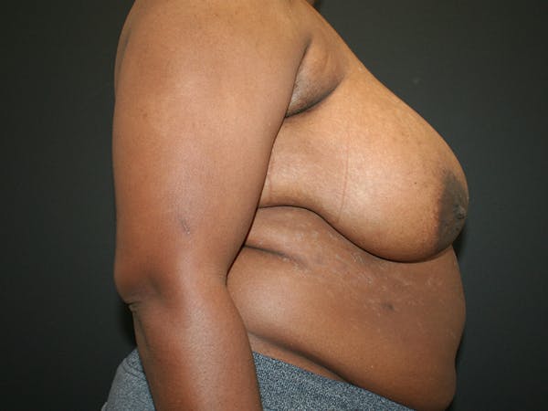 Breast Reduction Before & After Gallery - Patient 61447065 - Image 5