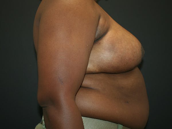 Breast Reduction Before & After Gallery - Patient 61447065 - Image 6