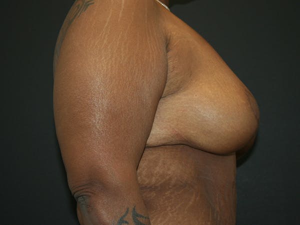 Breast Reduction Before & After Gallery - Patient 61447066 - Image 4