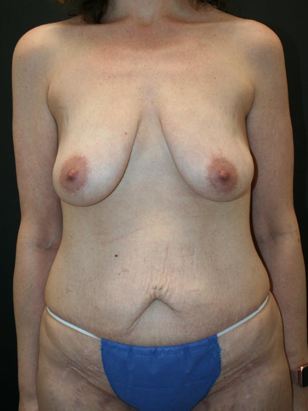 Massive Weight Loss Before & After Gallery - Patient 61782425 - Image 1