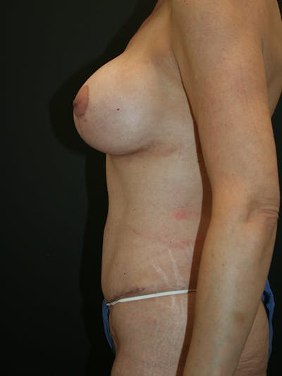 Massive Weight Loss Before & After Gallery - Patient 61782425 - Image 4