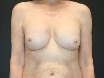 Breast Revision Before & After Gallery - Patient 61784198 - Image 1