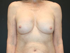Breast revision results