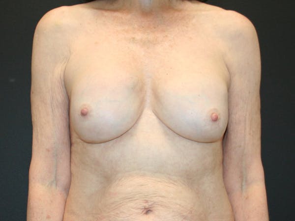 Breast Revision Before & After Gallery - Patient 61784198 - Image 1