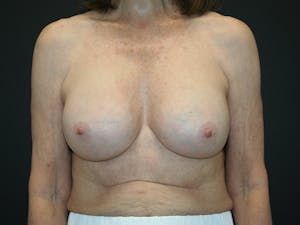 Breast revision results