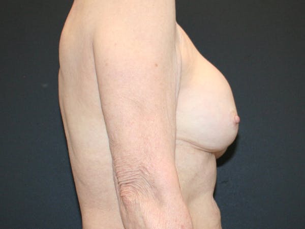 Breast Revision Before & After Gallery - Patient 61784198 - Image 3
