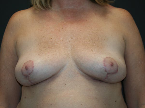 Breast Revision Before & After Gallery - Patient 61784199 - Image 2