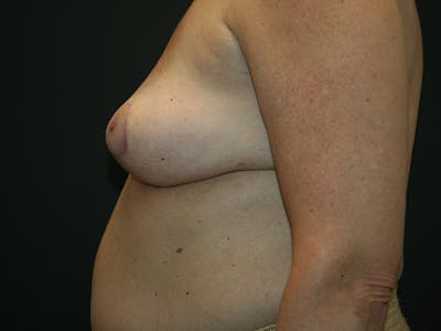 Breast Revision Before & After Gallery - Patient 61784199 - Image 4