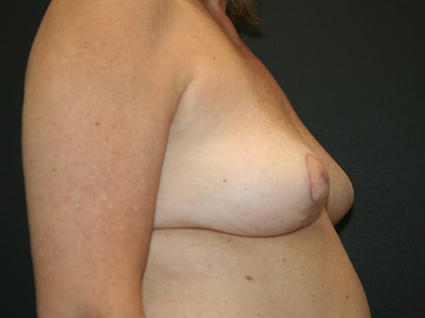 Breast Revision Before & After Gallery - Patient 61784199 - Image 6