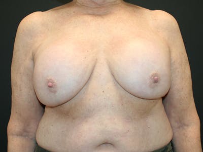 Breast Revision Before & After Gallery - Patient 61784200 - Image 1