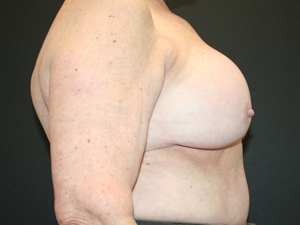 Breast Revision Before & After Gallery - Patient 61784200 - Image 3