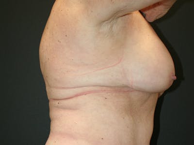 Breast Revision Before & After Gallery - Patient 61784200 - Image 4