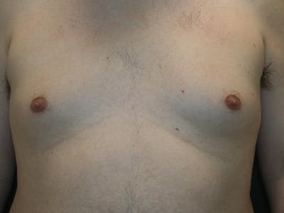Gynecomastia  Before & After Gallery - Patient 61784764 - Image 1