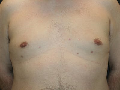 Gynecomastia  Before & After Gallery - Patient 61784764 - Image 2