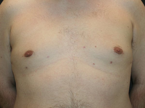Gynecomastia  Before & After Gallery - Patient 61784764 - Image 2