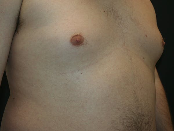 Gynecomastia  Before & After Gallery - Patient 61784764 - Image 3