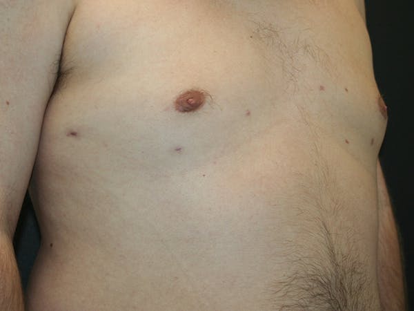 Gynecomastia  Before & After Gallery - Patient 61784764 - Image 4