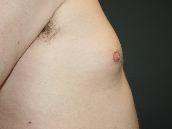 Gynecomastia  Before & After Gallery - Patient 61784764 - Image 5