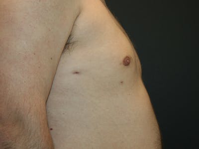 Gynecomastia  Before & After Gallery - Patient 61784764 - Image 6