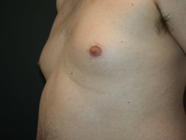Gynecomastia  Before & After Gallery - Patient 61784764 - Image 7