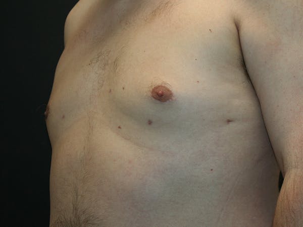 Gynecomastia  Before & After Gallery - Patient 61784764 - Image 8
