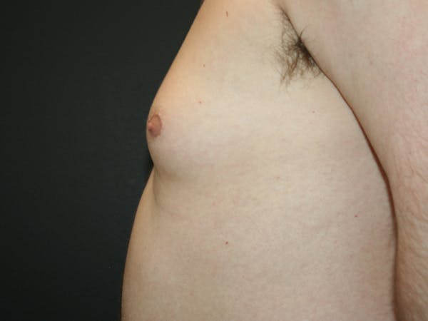 Gynecomastia  Before & After Gallery - Patient 61784764 - Image 9