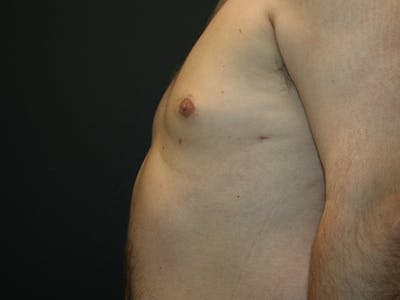 Gynecomastia  Before & After Gallery - Patient 61784764 - Image 10