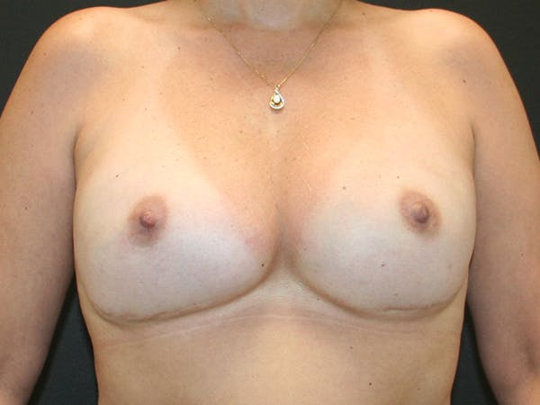 Breast Reconstruction Before & After Gallery - Patient 63629052 - Image 1