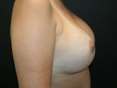 Breast Reconstruction Gallery - Patient 63629052 - Image 4