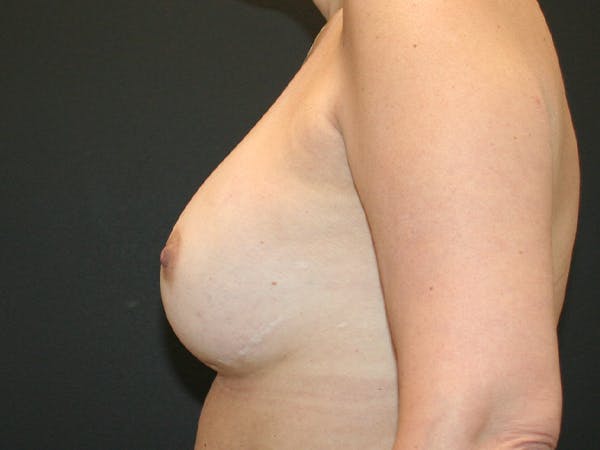 Breast Reconstruction Before & After Gallery - Patient 63629052 - Image 5