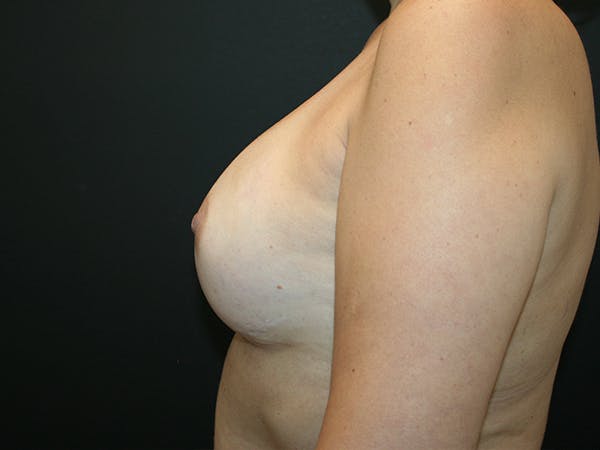 Breast Reconstruction Before & After Gallery - Patient 63629052 - Image 6