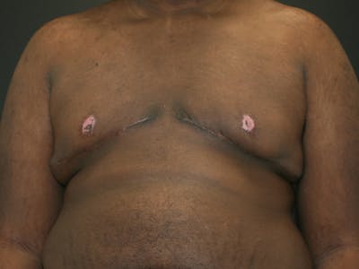 Gynecomastia  Before & After Gallery - Patient 63629057 - Image 2