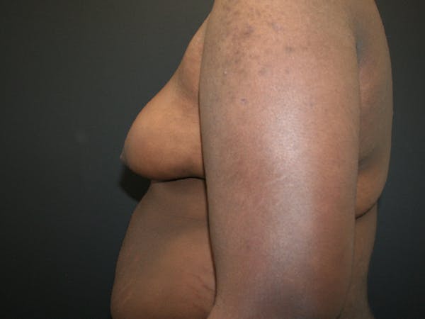 Gynecomastia  Before & After Gallery - Patient 63629057 - Image 3