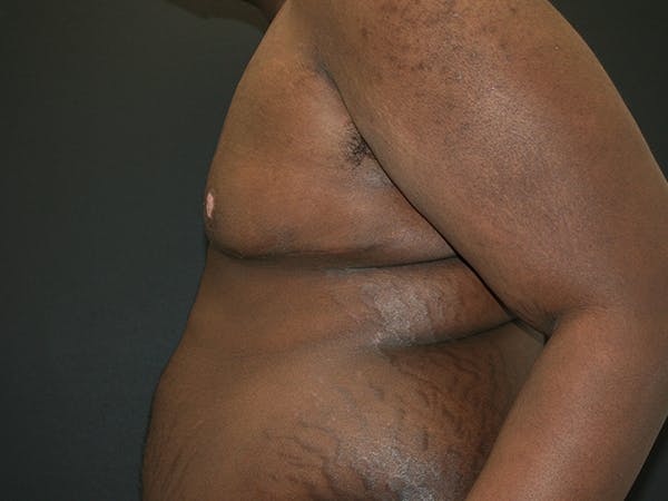 Gynecomastia  Before & After Gallery - Patient 63629057 - Image 4