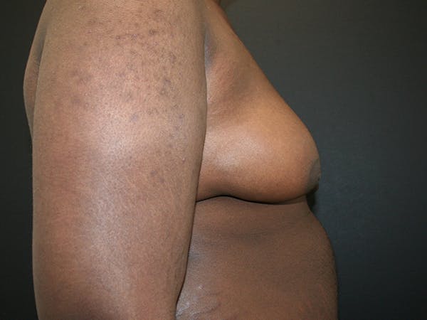 Gynecomastia  Before & After Gallery - Patient 63629057 - Image 5
