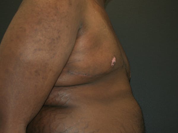 Gynecomastia  Before & After Gallery - Patient 63629057 - Image 6