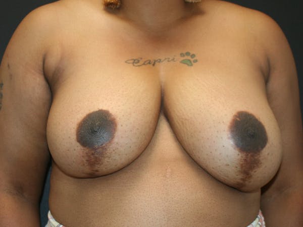 Breast Reduction Before & After Gallery - Patient 63629079 - Image 1