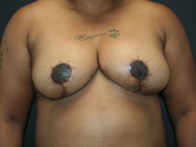 Breast Reduction Before & After Gallery - Patient 63629079 - Image 2