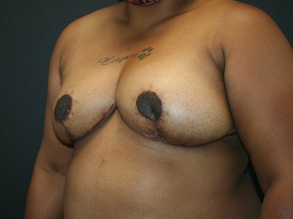 Breast Reduction Gallery - Patient 63629079 - Image 4